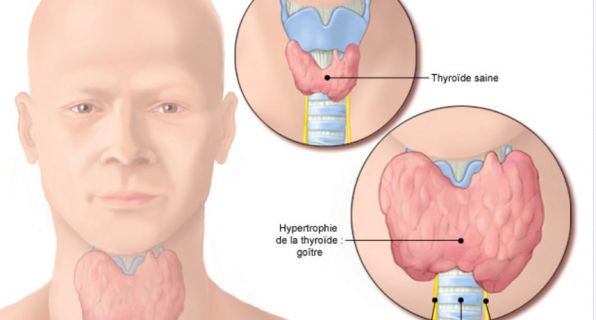 Les troubles thyroïdiens